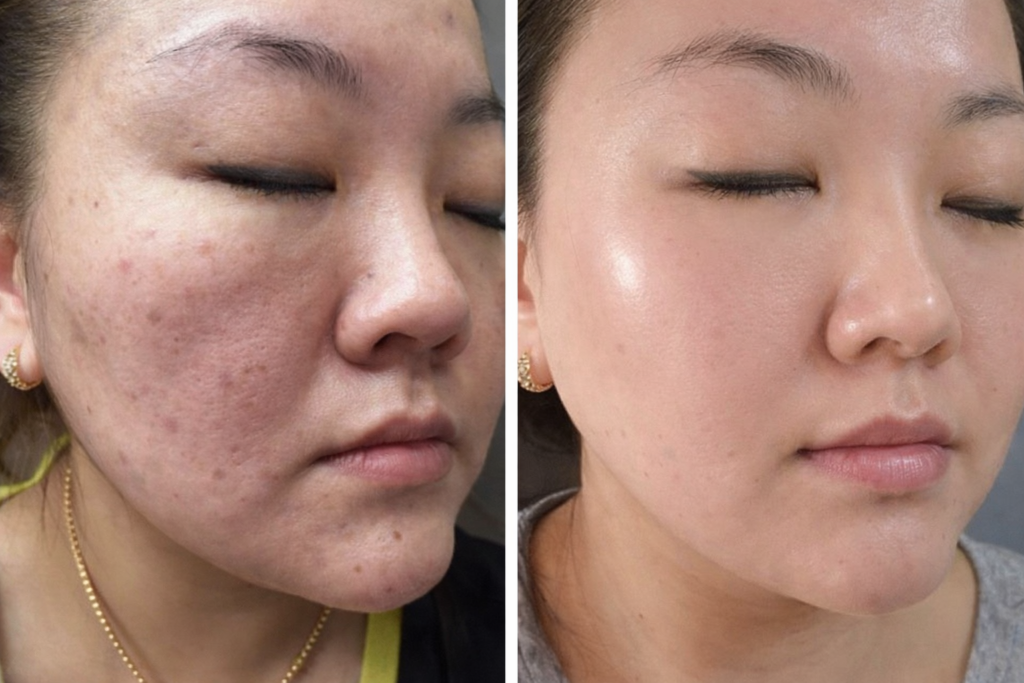 Skincare transformation in two stages